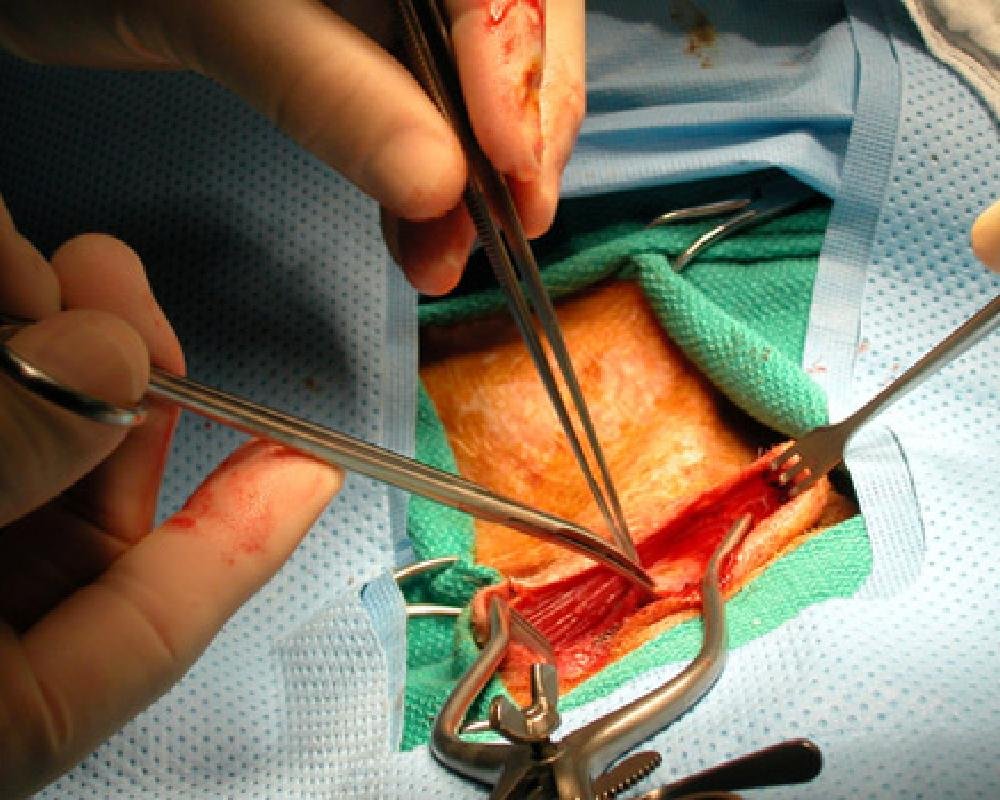 Close-up of open-heart surgery at Cardiac Care Associates, Bhopal, showing precise surgical technique by expert cardiac surgeons.