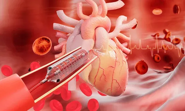 Illustration showing coronary artery stent placement and heart anatomy at Cardiac Care Associates, best cardiac care centre in Bhopal.