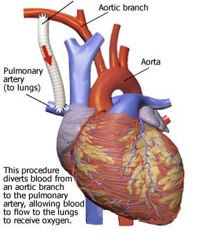 Medical diagram of Blalock-Taussig shunt diverting blood from aortic branch to pulmonary artery for oxygenation at Cardiac Care Associates, best cardiac care centre in Bhopal.