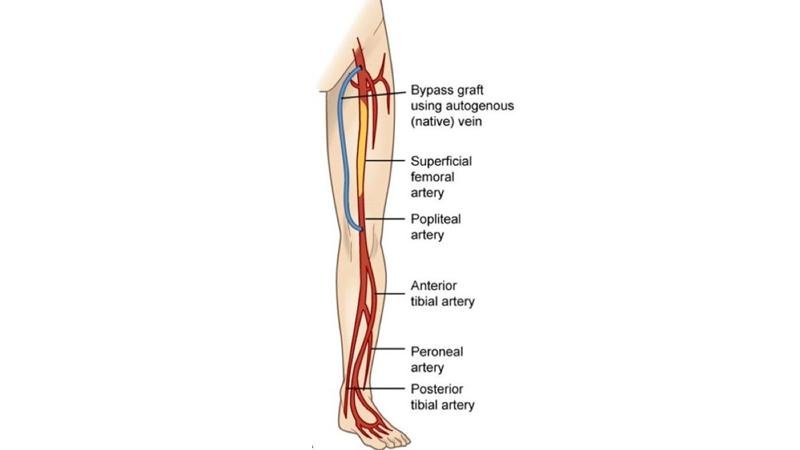 Diagram of arterial bypass graft in the leg, showing native vein graft and major arteries at Cardiac Care Associates, best cardiac care centre in Bhopal.