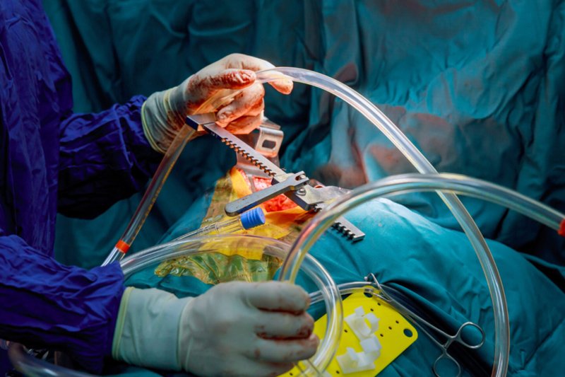 Close-up of open-heart surgery with bypass tubing and rib spreader performed by specialists at Cardiac Care Associates, best cardiac care centre in Bhopal.