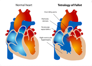 Comparison illustration of normal heart anatomy and Tetralogy of Fallot with labeled defects at Cardiac Care Associates, best cardiac care centre in Bhopal.