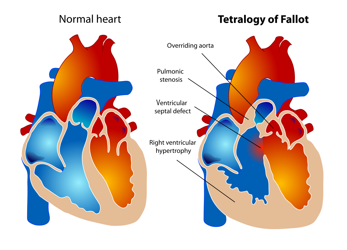 Comparison illustration of normal heart anatomy and Tetralogy of Fallot with labeled defects at Cardiac Care Associates, best cardiac care centre in Bhopal.