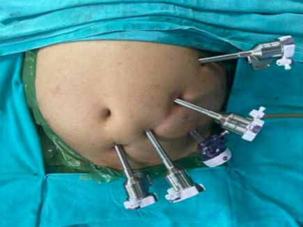 Laparoscopic surgery ports placed on a patient’s abdomen at Cardiac Care Associates, best cardiac care centre in Bhopal.