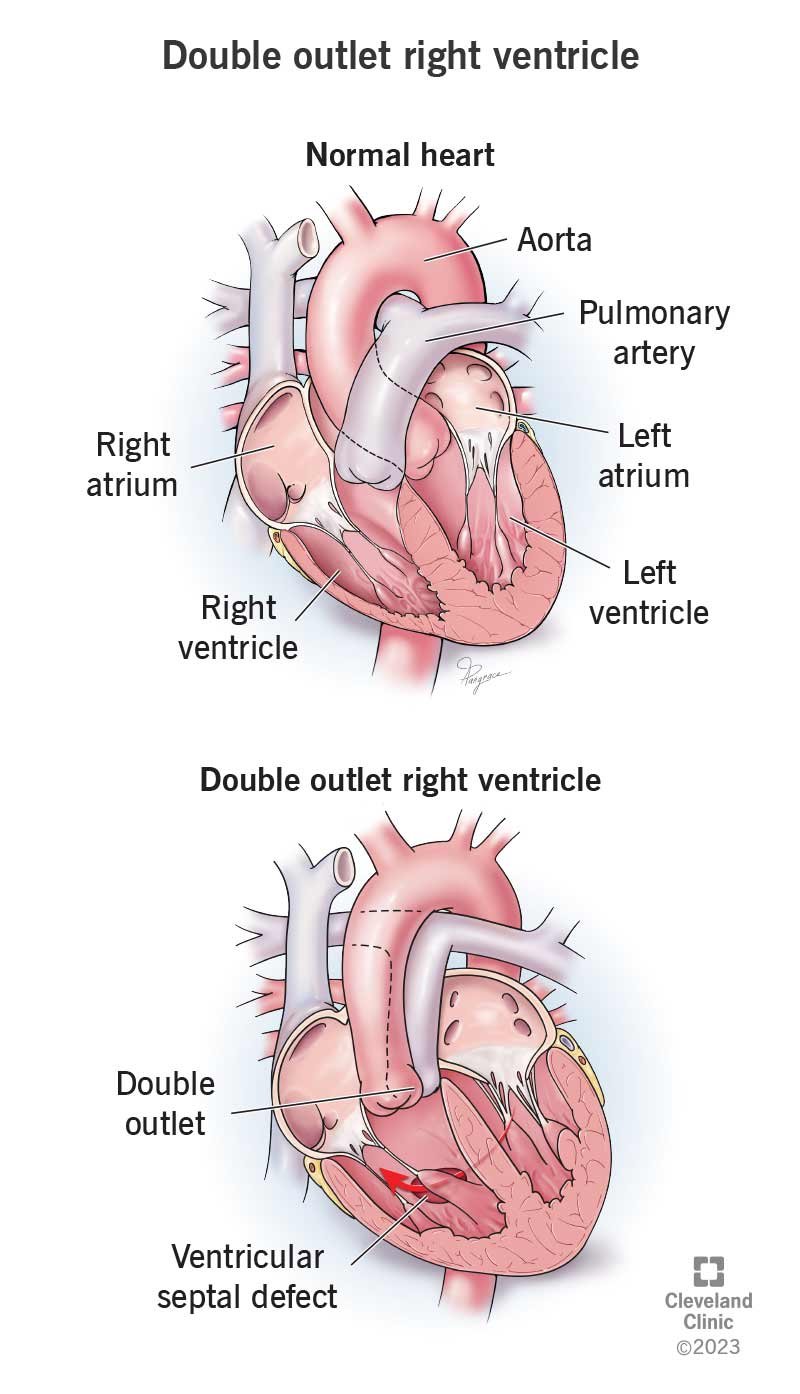 Comparison of normal heart anatomy and double outlet right ventricle (DORV) with ventricular septal defect at Cardiac Care Associates, best cardiac care centre in Bhopal.