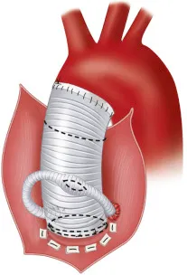 Dacron graft repair in aortic surgery for aneurysm at Cardiac Care Associates, best cardiac care centre in Bhopal.