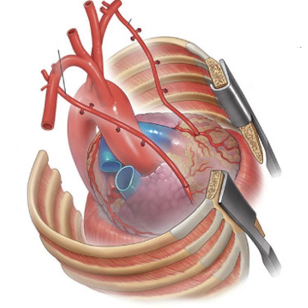 heart during open-chest surgery showing blood vessels, ribs, and surgical instruments.