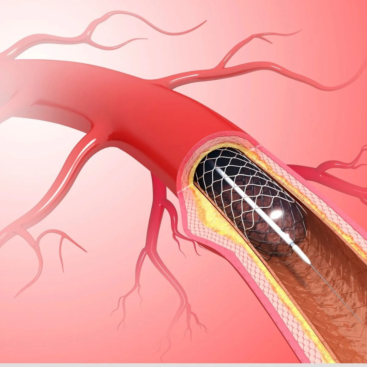 Illustration of a coronary artery with a stent inserted during angioplasty to widen a blocked artery.