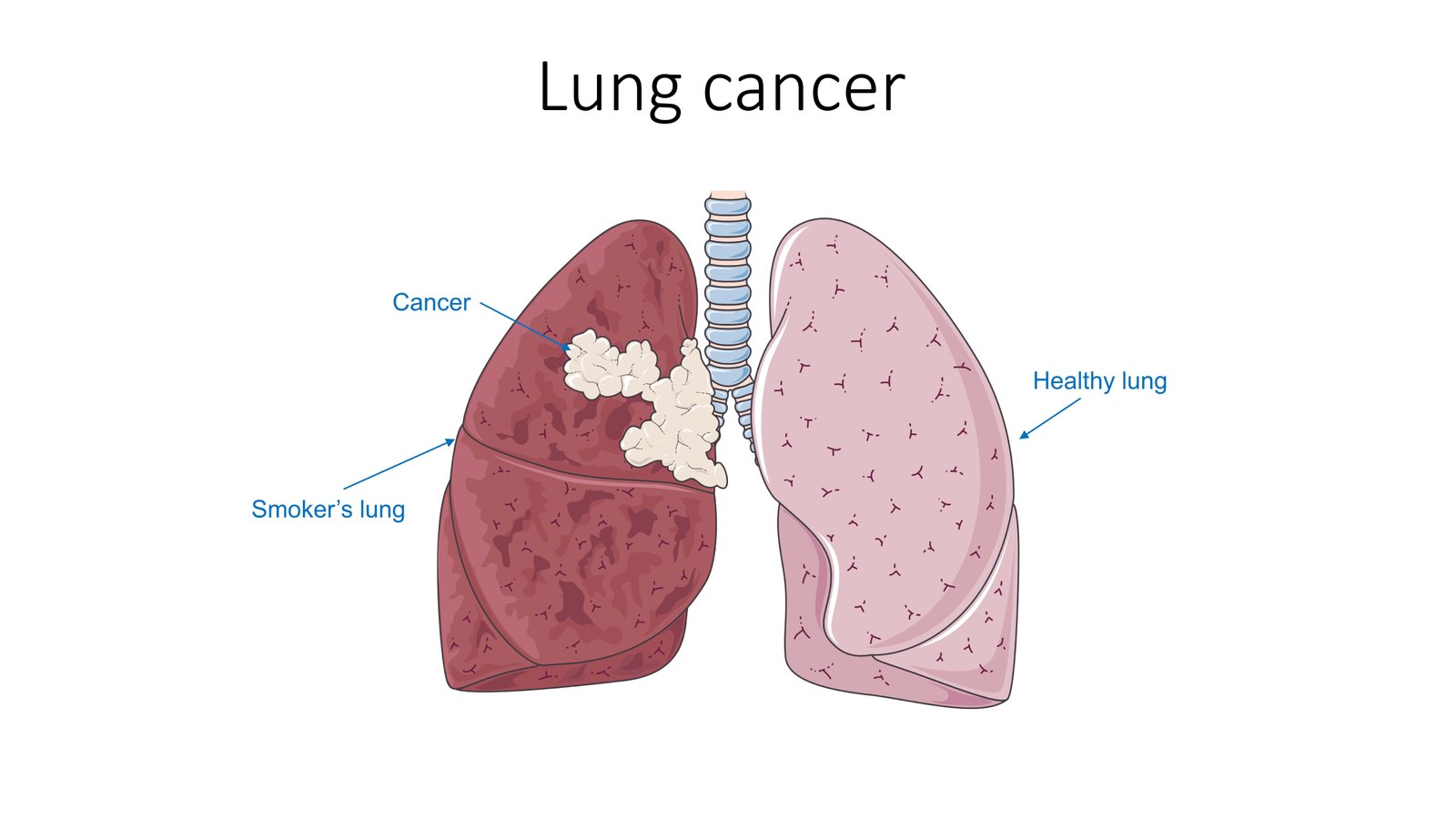 Medical diagram comparing healthy lung, smoker’s lung, and cancerous growth at Cardiac Care Associates, best cardiac care centre in Bhopal.