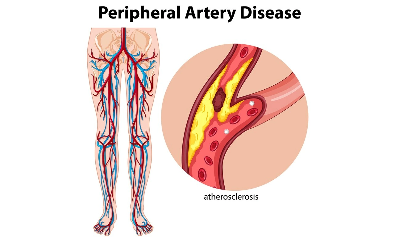 Medical illustration of lower limb arteries and atherosclerosis in peripheral artery disease at Cardiac Care Associates, best cardiac care centre in Bhopal.