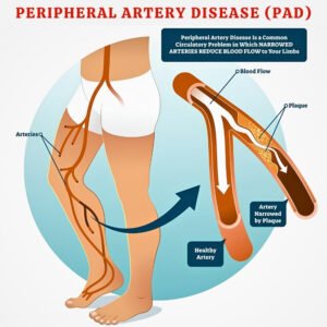 Peripheral Artery Disease PAD symptoms showing blocked leg arteries, reduced blood flow, leg pain, and poor circulation